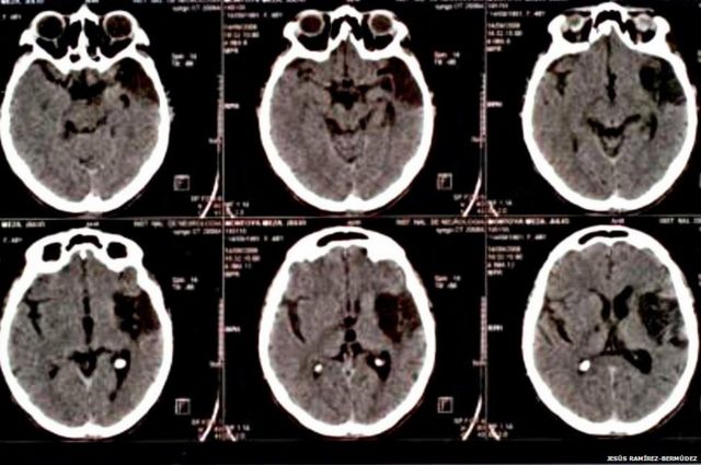 A esquerda brasileira e a síndrome de Cotard
